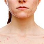 Excoriation (Skin Picking) Disorder, aka Dermatillomania
