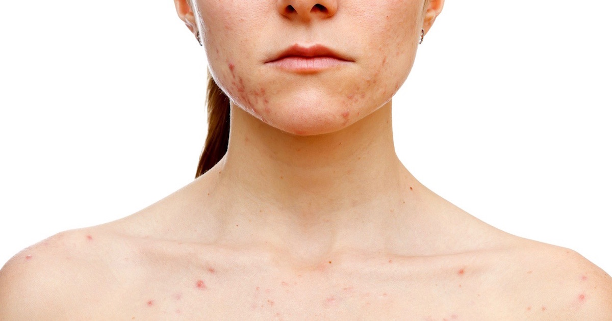 Excoriation (Skin Picking) Disorder, aka Dermatillomania